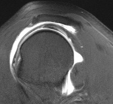 Os Acrominale MRI T2